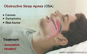 Image result for Osa Sleep Apnea