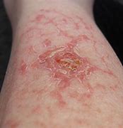 Image result for Spider Rash