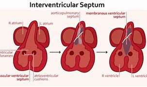 Image result for Myocardium of Interventricular Septum