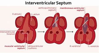 Image result for Interventricular Septum