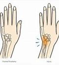 Image result for Outer Wrist Pain