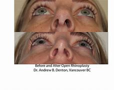 Image result for Nasal Alar Groove