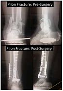 Image result for Surgical Approach of Pilon Fracture