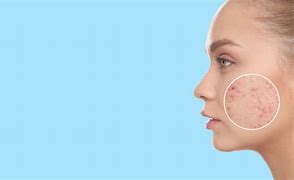 Image result for Acne On Side of Face