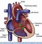 Image result for Complete Atrioventricuar Canal