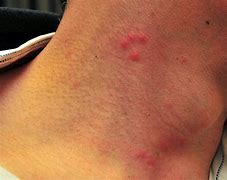 Image result for Benedryl Bug Bites