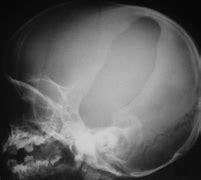 Image result for Skull Fracture