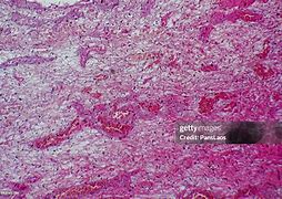 Image result for Hemangioma Tumor