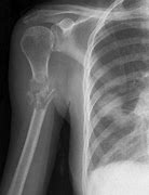 Image result for Osseous Metastatic Disease