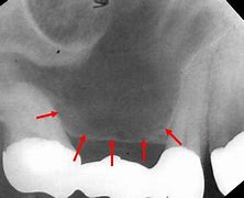 Image result for Molarized Premolars