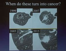 Image result for Lung Cancer On CT