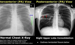 Image result for Chest X-ray of TB