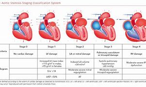 Image result for Aortic Stenosis Severity Table