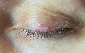 Image result for Head of Eyelaash Mites