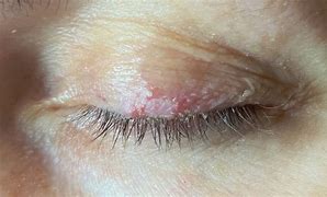 Image result for Eyelaash Mites