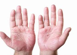 Image result for Eczema On Hands