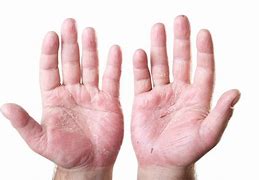 Image result for Baby Eczema Hands