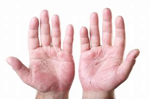 Image result for Eczema Rash On Hands