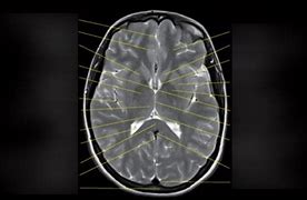 Image result for Coronal Plane Brain MRI