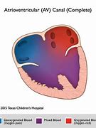 Image result for Complete Atrioventricular Canal Defect