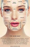 Image result for Acne Boy Face Map