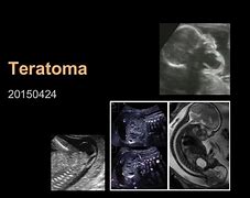 Image result for Teratoma