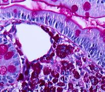 Image result for Whipple Specimen Gross Pathology