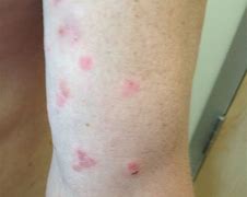 Image result for 10 Common Skin Rashes On Legs