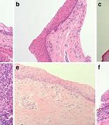 Image result for Punctal Stenosis