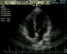 Image result for Interatrial Septum Lipomatous Hypertrophy Echo