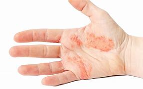 Image result for Eczema On Hands