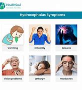 Image result for Hydrocephalus