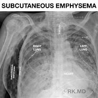 Image result for Legs Emphysema X-ray