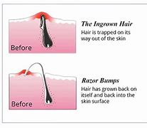 Image result for Ingrown Hair Causing Boils