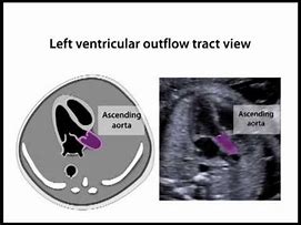 Image result for Anatomical Site of Left Ventricular Outflow Tract