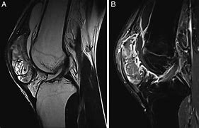 Image result for Capitate Sagittal Imaging