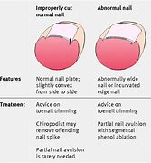 Image result for Ingrown Nail