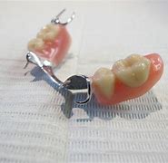 Image result for Metal-Based Partial Dentures