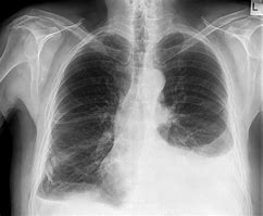 Image result for Pleural Effusion Images