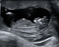 Image result for Anencephaly Ultrasound