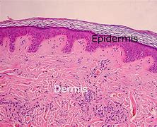 Image result for Dermis Skin Cut