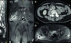 Image result for CT Angiogram Abdomen