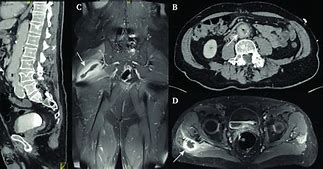 Image result for CT Angiogram Abdomen