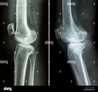 Image result for Normal Lateral Knee Radiograph