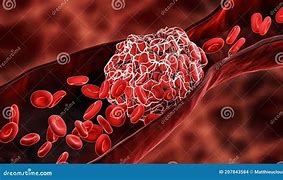 Image result for What Is a Thrombus