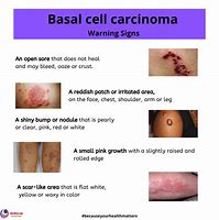 Image result for Basal Cell Carcinoma Cancer Symptoms