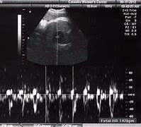 Image result for Head Circumference 37 Weeks Ultrasound