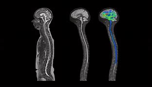 Image result for Diffusion MRI