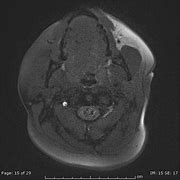 Image result for Vertebral Dissection On Angiogram