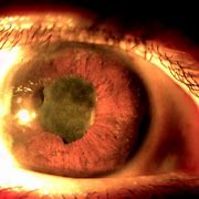 Image result for HLA Gene Uveitis